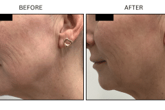 LB Lasers Morpheus8 - Patient17b