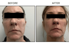 LB Lasers Morpheus8 - Patient19a