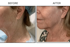 LB Lasers Morpheus8 - Patient20a