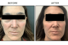 LB Lasers Morpheus8 - Patient22