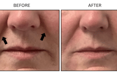 LB Fillers Nasolabial Folds Smile Lines - Patient1