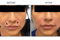 LB Fillers Nasolabial Folds Smile Lines - Patient2