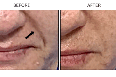 LB Fillers Nasolabial Folds Smile Lines - Patient5