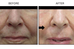 LB Fillers Nasolabial Folds Smile Lines - Patient6