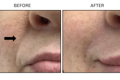 LB Fillers Nasolabial Folds Smile Lines - Patient7