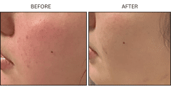 LB Medical Rosacea - Patient1
