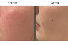 LB Medical Rosacea - Patient1