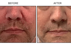 LB Medical Rosacea - Patient2