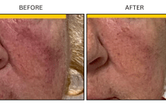 LB Medical Rosacea - Patient3
