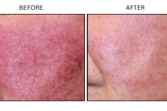 LB Medical Rosacea - Patient4