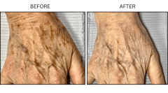 LB Medical Sun Freckles Spots - Patient2