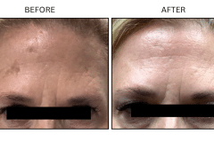 LB Medical Sun Freckles Spots - Patient1