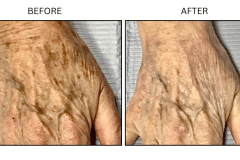 LB Medical Sun Freckles Spots - Patient2