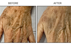 LB Medical Sun Freckles Spots - Patient2b