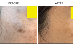 LB Medical Sun Freckles Spots - Patient3