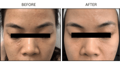 LB Medical Syringomas - Patient1