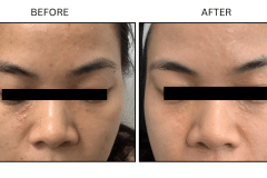 LB Medical Syringomas - Patient1