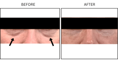 LB Fillers Under Eyes - Patient4