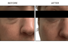LB Fillers Under Eyes - Patient1