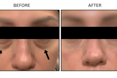 LB Fillers Under Eyes - Patient2