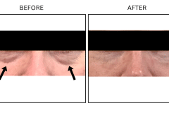 LB Fillers Under Eyes - Patient4