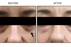 LB Fillers Under Eyes - Patient5