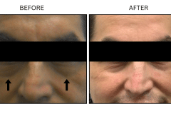 LB Fillers Under Eyes - Patient6