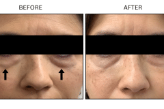 LB Fillers Under Eyes - Patient7