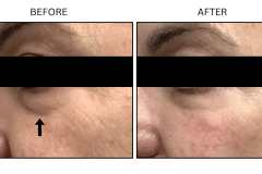 LB Fillers Under Eyes - Patient8