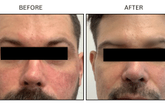 LB Lasers Vbeam - Patient1a
