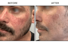 LB Lasers Vbeam - Patient1b