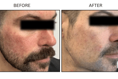 LB Lasers Vbeam - Patient1c