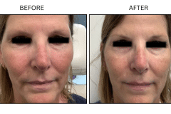 LB Lasers Vbeam - Patient2b