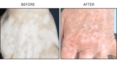 LB Medical Vitiligo - Patient1b