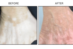 LB Medical Vitiligo - Patient1a