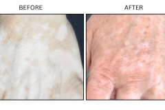 LB Medical Vitiligo - Patient1b
