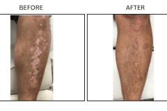 LB Medical Vitiligo - Patient2
