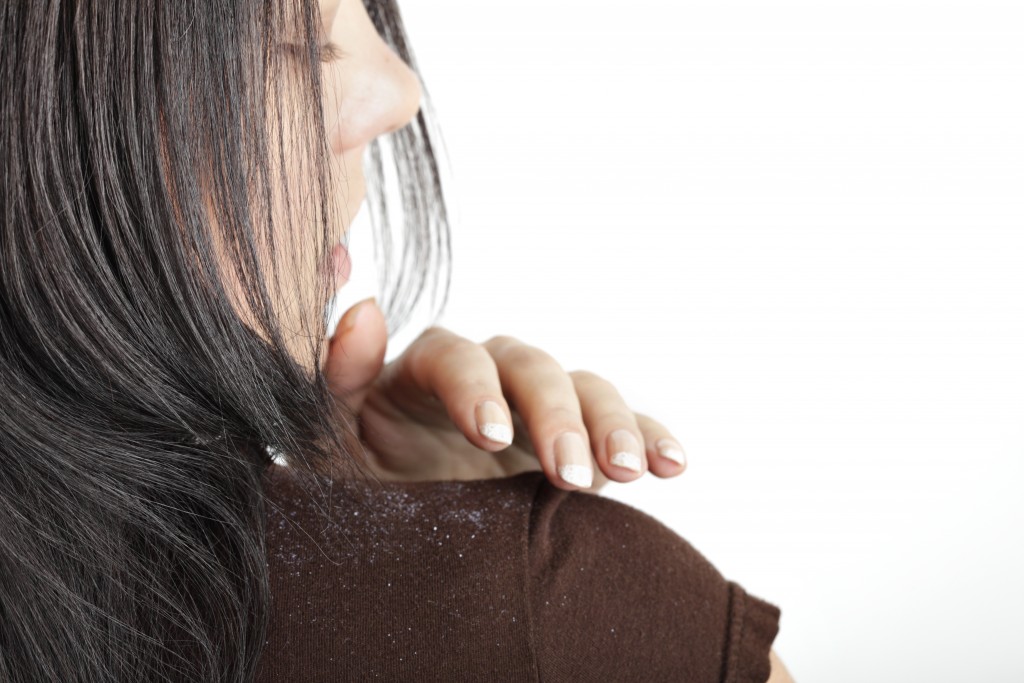 Dandruff on shirt