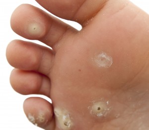 Warts on foot
