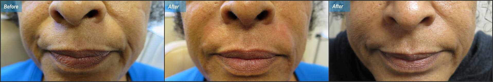 before & after image of dermal fillers to correct nasolabial folds