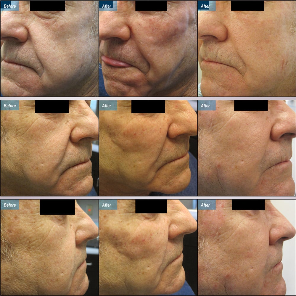 Before / Immediately After / 2 Weeks After
