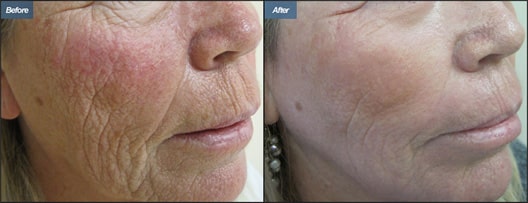 Before and after a single laser treatment. Notice the youthful appearance of the skin after<br> this simple in-office procedure.