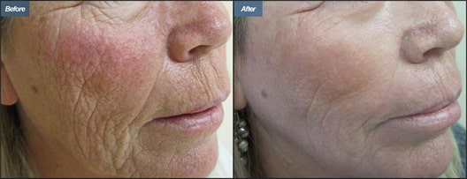 Laser Resurfacing Results