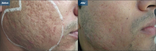 Laser Resurfacing Results