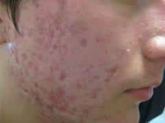 Scarring caused by inflammatory<br> acne.