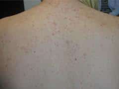 close-up image of acne on someone's upper back and shoulders