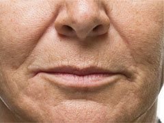 Before fillers to nasolabial folds.