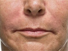 after image of nasolabial folds after being corrected by dermal fillers