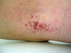 Sub-acute eczema characterized by<br> lichenification (thickening of skin),<br> scaling, and excoriation marks.