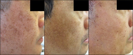 Before IPL treatment / 8 months after / 3 years after IPL treatment